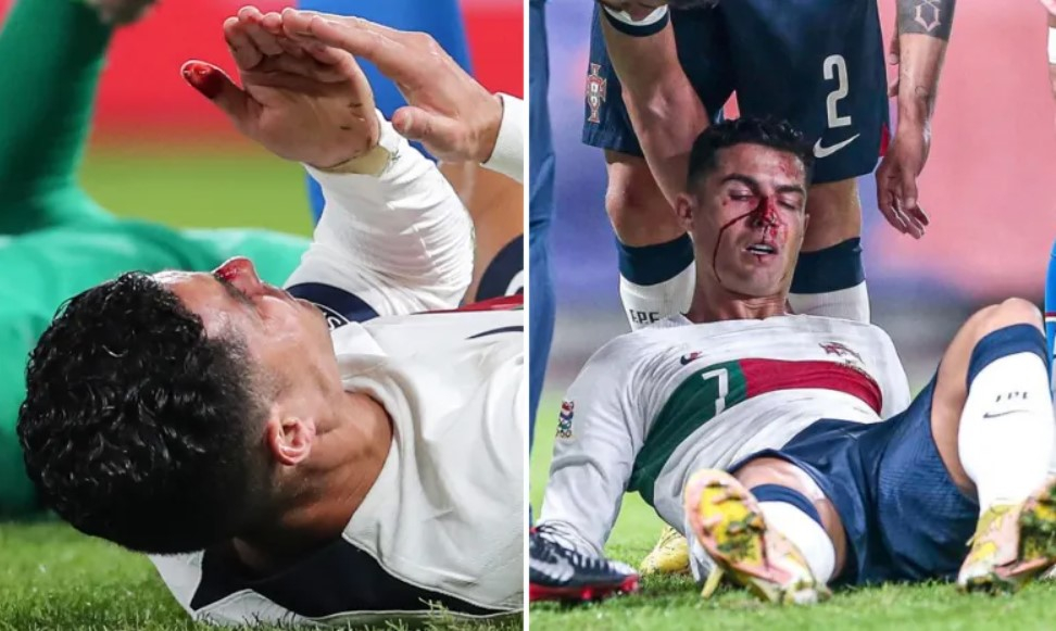 Cận cảnh pha bóng Cristiano Ronaldo đổ máu có khả năng bị gãy mũi