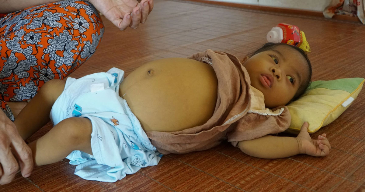 Người mẹ nghèo khẩn cầu cứu con gái 8 tháng tuổi bị teo mật bẩm sinh