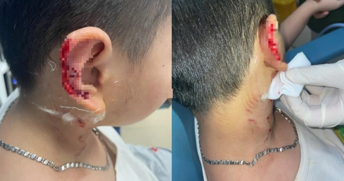 Hà Nội: Bé 8 tuổi bị chó Phú Quốc cào đứt một phần tai