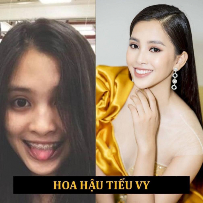 10 hoa hậu lột xác nhờ niềng răng: HHen Niê, Kỳ Duyên, Tiểu Vy đẹp rạng rỡ khiến fans nức lòng