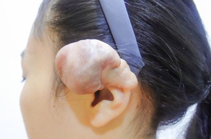 Bấm 6 lỗ tai, một phụ nữ bị biến dạng tai phải phẫu thuật nhiều lần