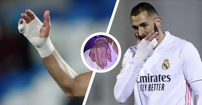 Bàn tay băng bó và nghị lực của Benzema