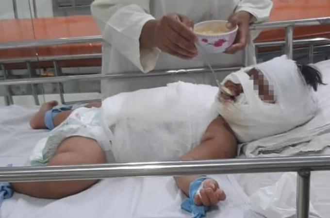 TPHCM: Bé gái 1 tuổi bỏng thương tâm vì ngã vào nồi nước sôi mẹ nấu