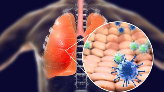 Bệnh suy hô hấp khiến TikToker Bích Tuyền qua đời nguy hiểm đến mức nào?