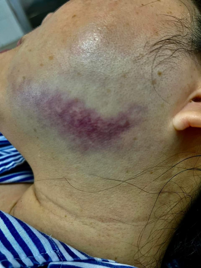 Quảng Ninh: Nữ công chứng viên bị người đàn ông nhổ nước bọt, đá sưng mặt