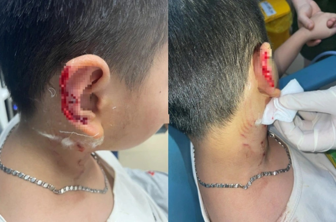 Hà Nội: Bé 8 tuổi bị chó Phú Quốc cào đứt một phần tai