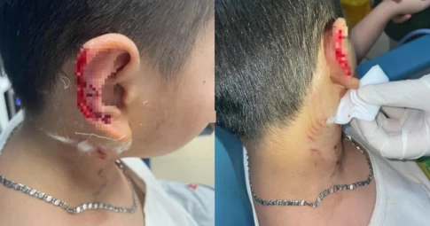 Hà Nội: Bé 8 tuổi bị chó Phú Quốc cào đứt một phần tai