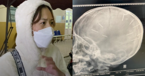 Vụ bé gái 3 tuổi bị bắn 9 cái đinh vào đầu: "Về ở với mẹ 8 tháng phải nhập viện 4 lần"